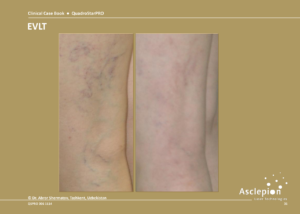 Endovascular Laser Terapi (EVLT)