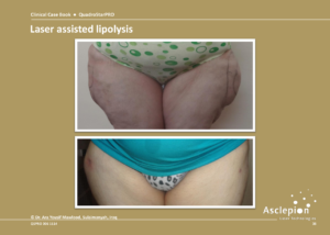 Laserassisterad lipolys